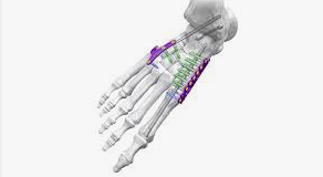 Medial Column Fusion Plate Report